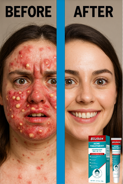 “Pure Herbal Power That Clears Acne Naturally 🌿”