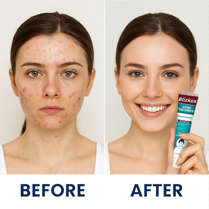 “Pure Herbal Power That Clears Acne Naturally 🌿”